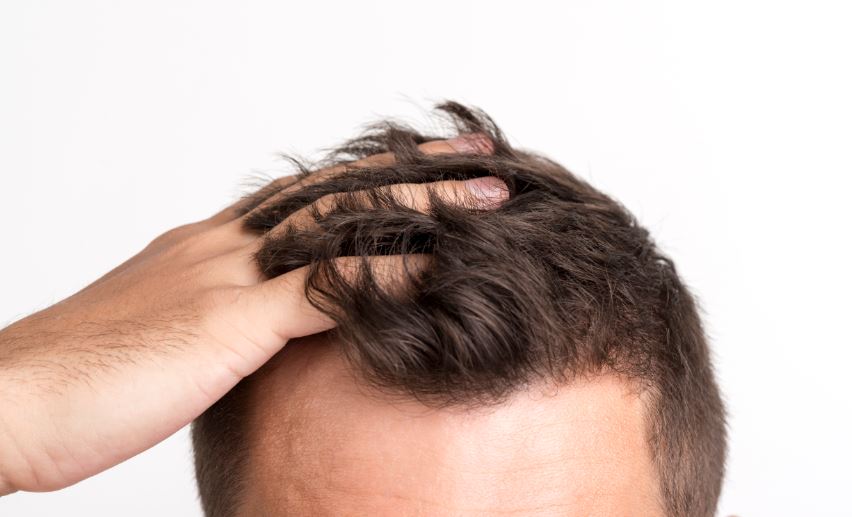 Hereditary Baldness: What to Expect and How You Can Treat It