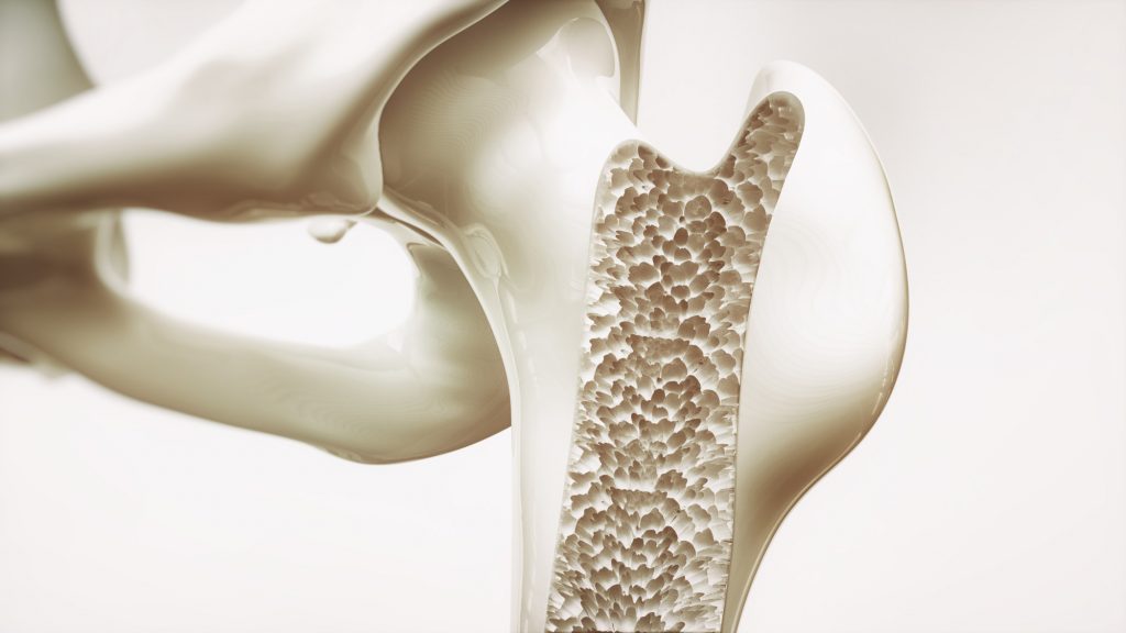 What Is Osteoporosis: A Comprehensive Guide