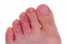 Athlete’s Foot – Causes, Symptoms, Treatments